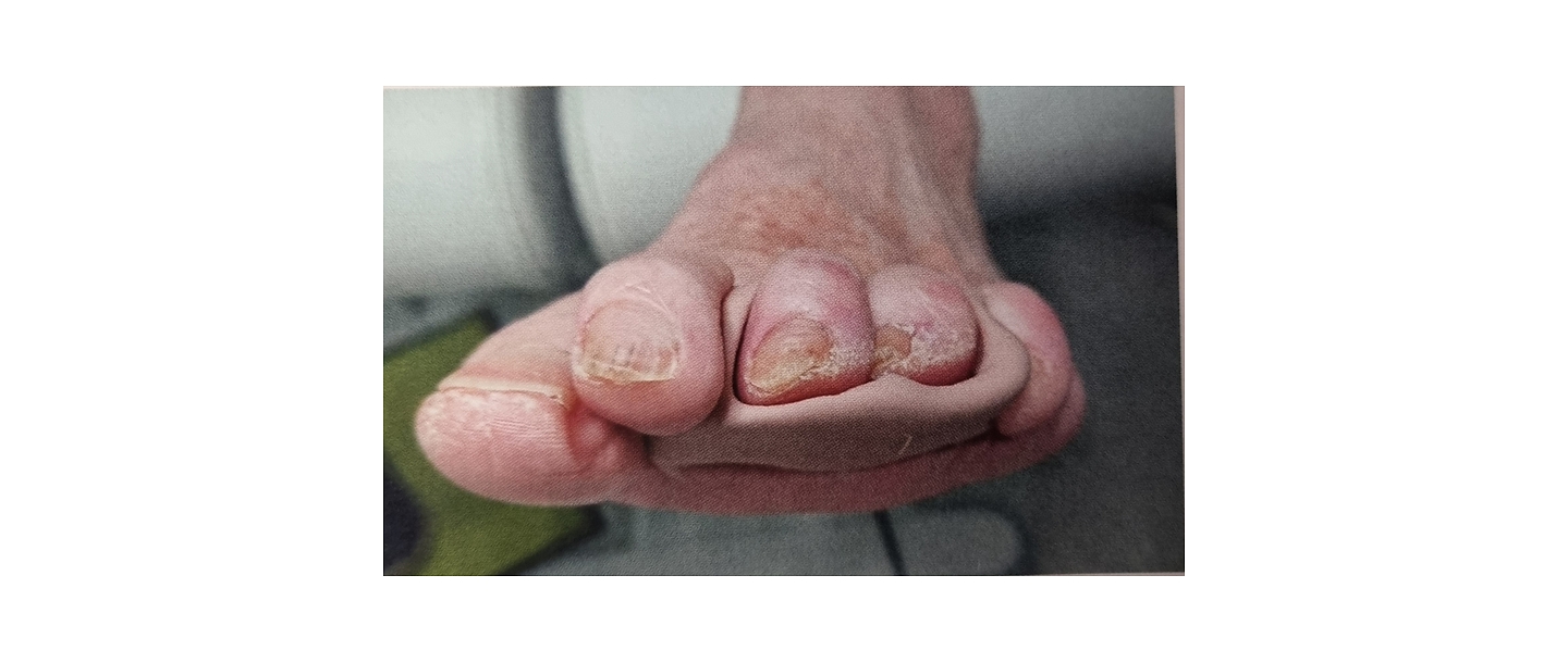 Изготовление индивидуальных ортезов