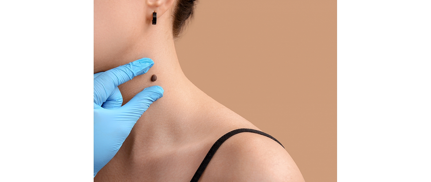 Ādas veidojuma (dzimumzīmes) profesionāla novērtēšana kakla zonā dermatologa kabinetā.