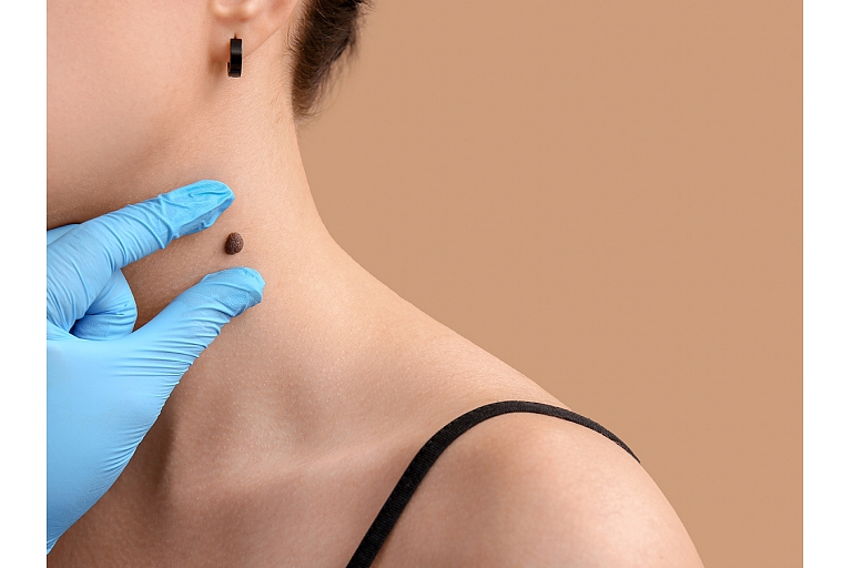 Skin formation( moles) professional evaluation of the neck area at a dermatologist's office.