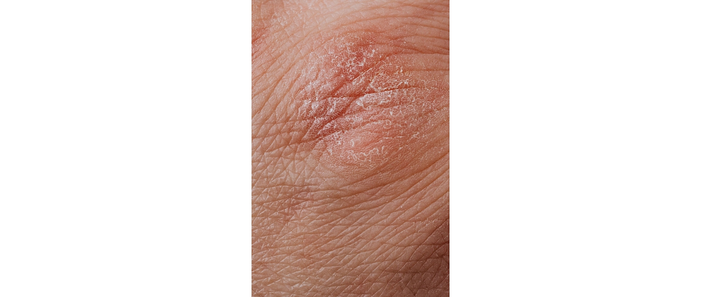 Examination of skin diseases