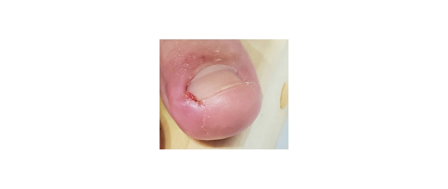 ingrown nail care