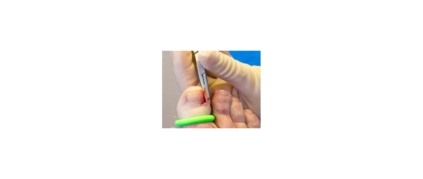ingrown nail care