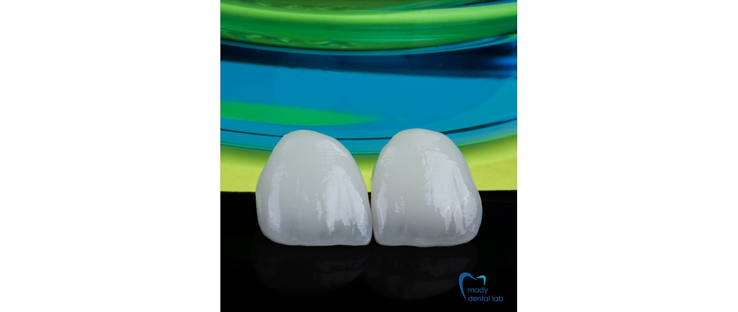 Pressed ceramic crowns