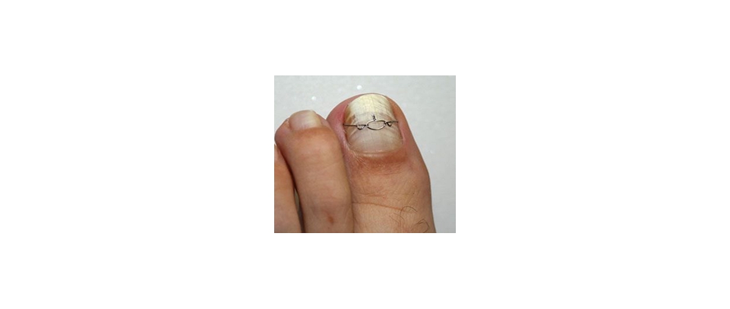 ingrown nail correction