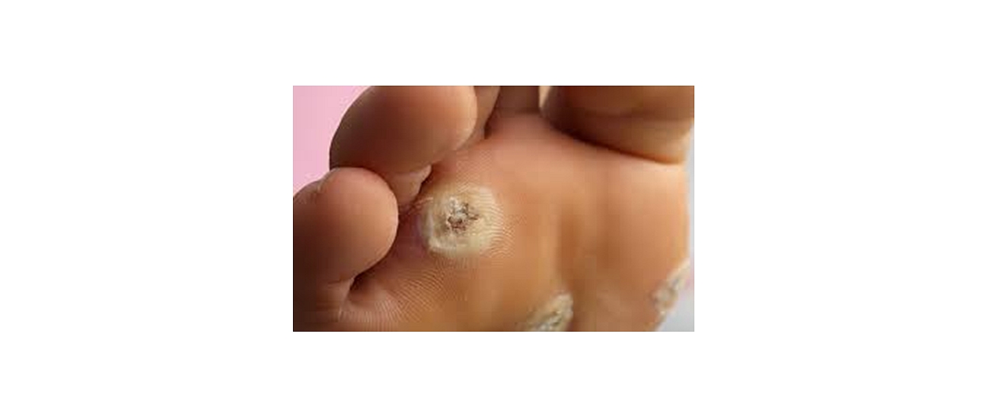 Wart or corn treatment