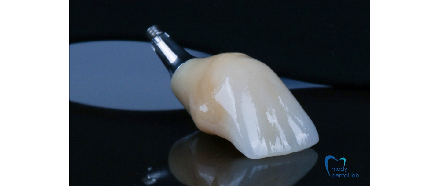 Crowns of different materials on implants