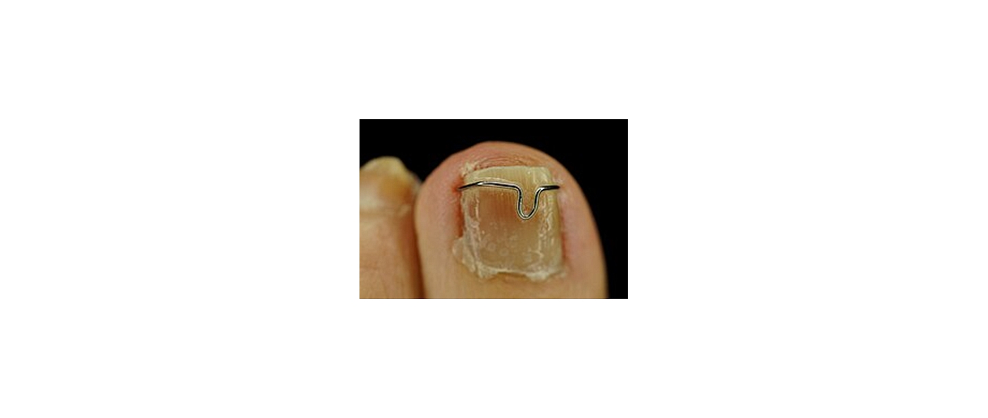 ingrown nail correction