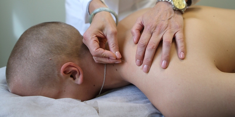 Acupuncture