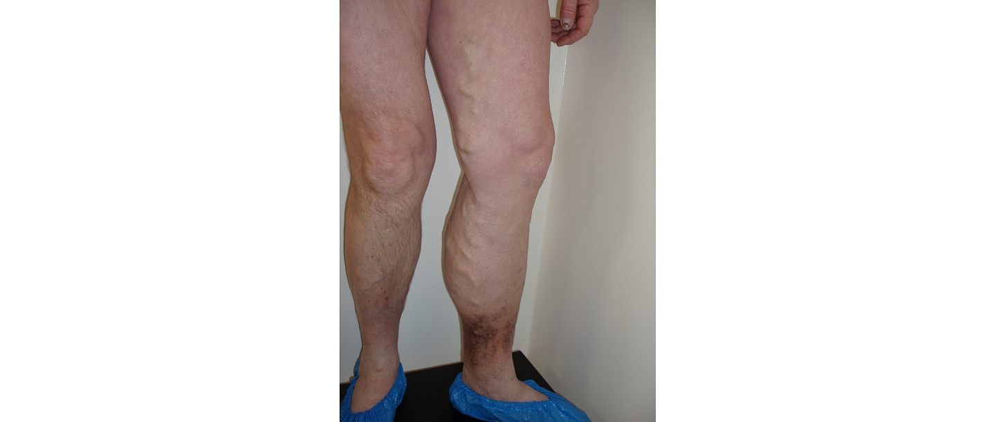 Vēnu ārstēšana operācijas Alūksnē Limbažos Madonā