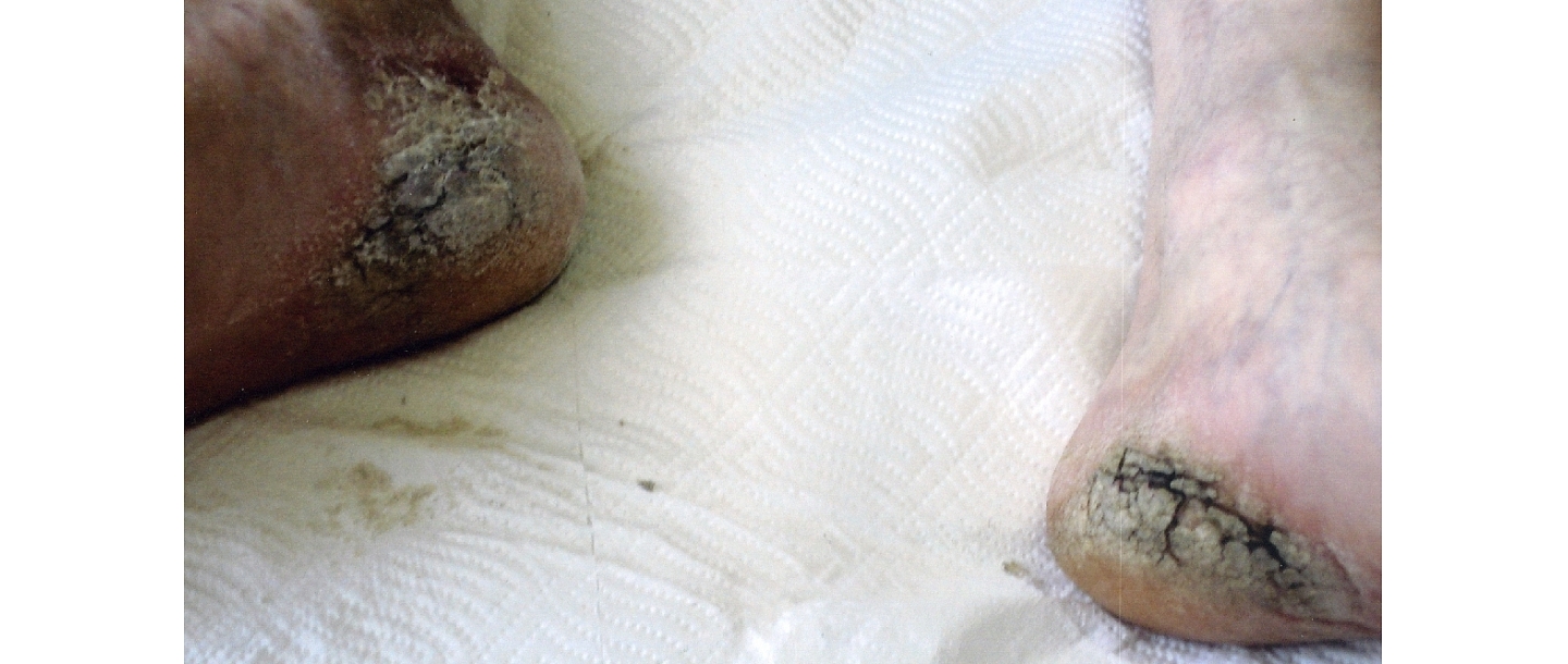 Treatment of skin fungus