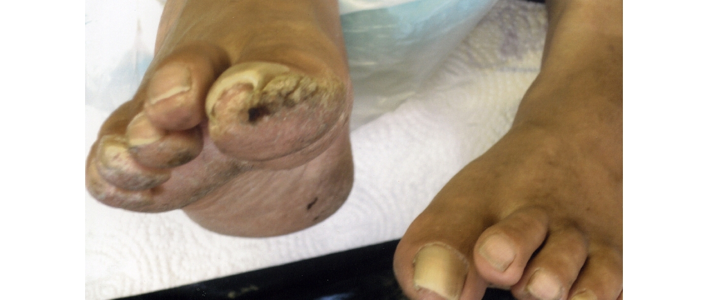 Treatment of mycosis