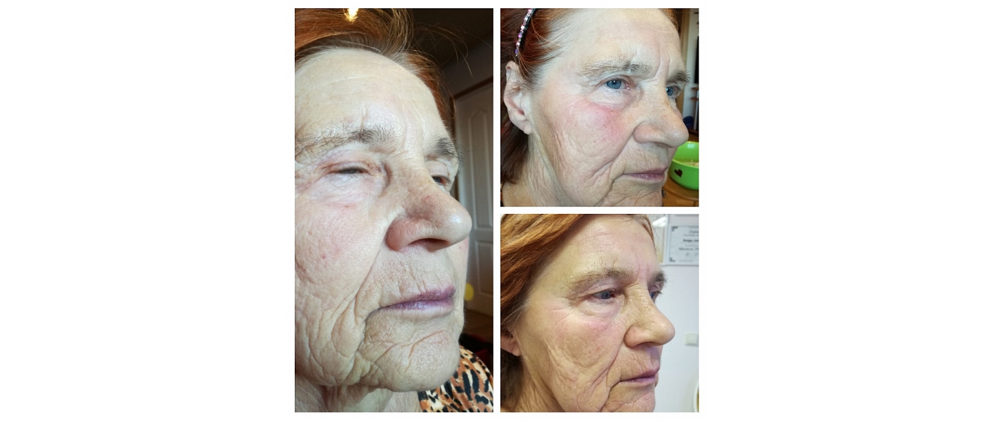 meso procedure for face