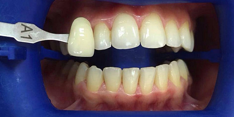 Zobu implanti Jelgavā