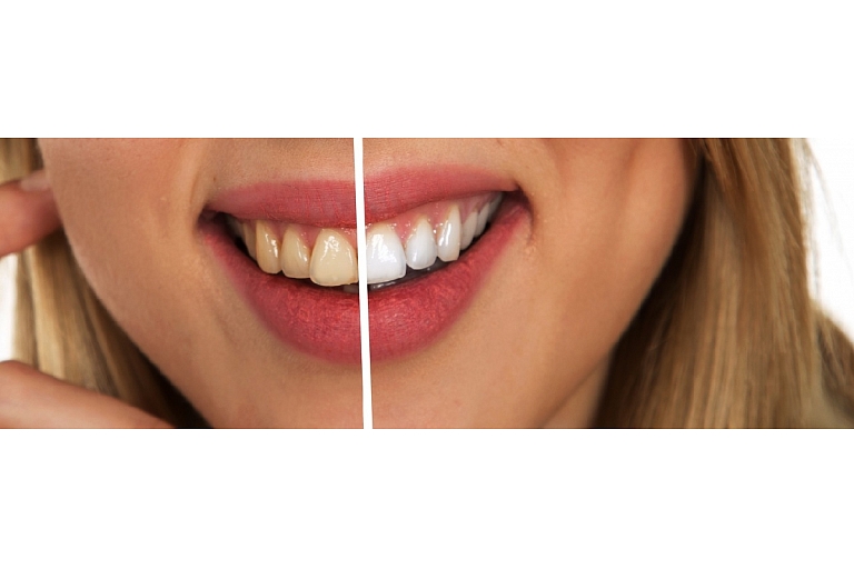 Teeth whitening