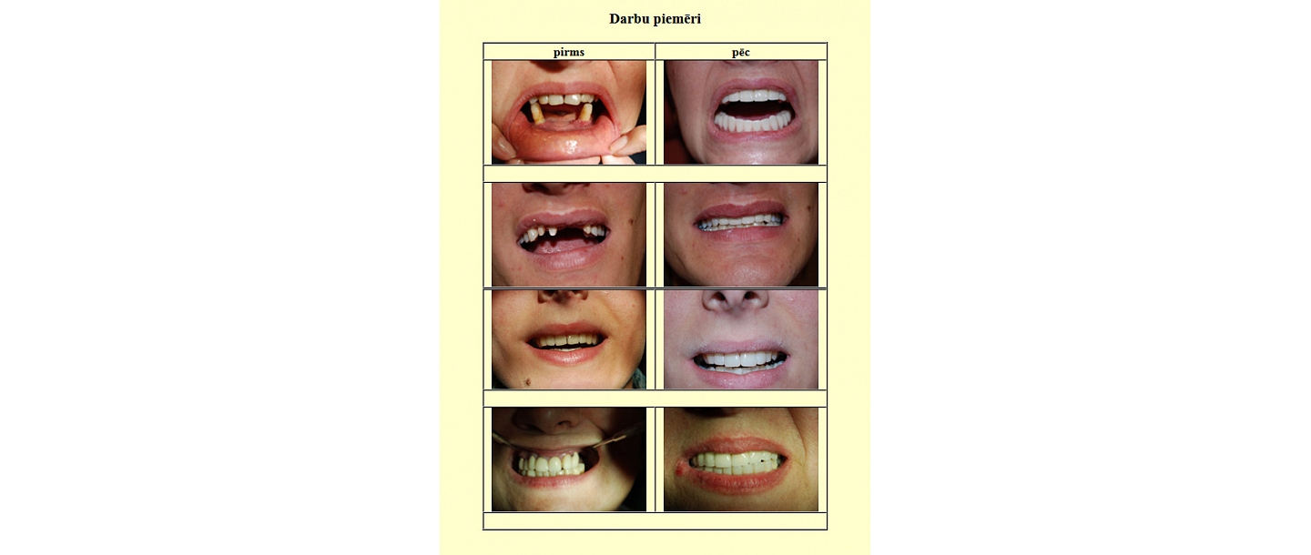 Teeth restoration