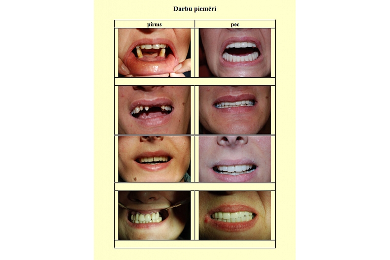 Teeth restoration