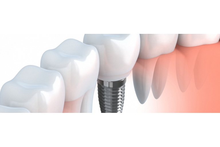 dental implantation