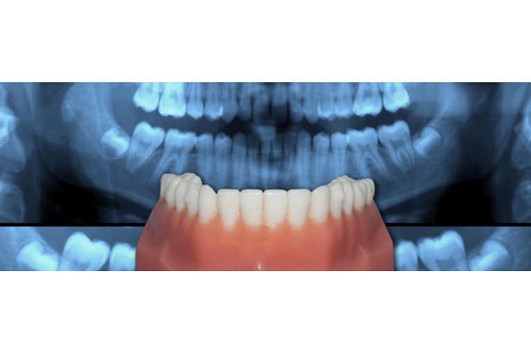dental treatment