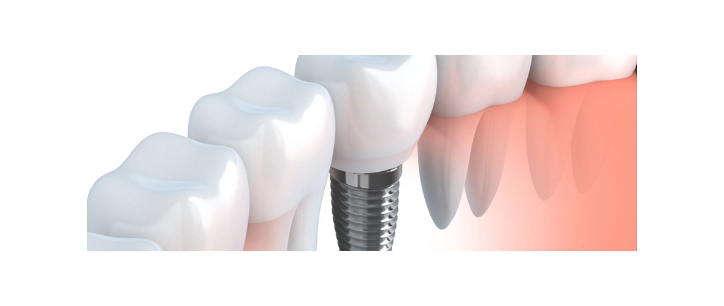 dental implantation