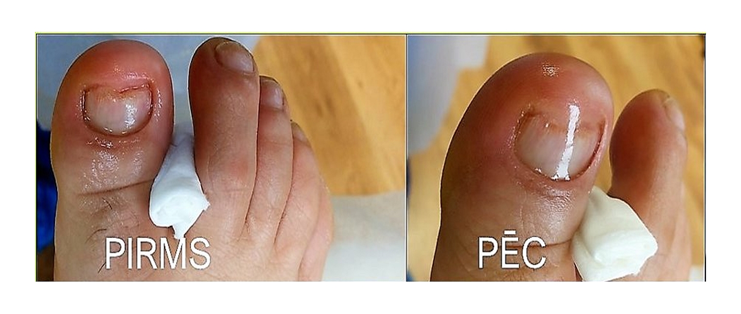 Damaged nail restoration