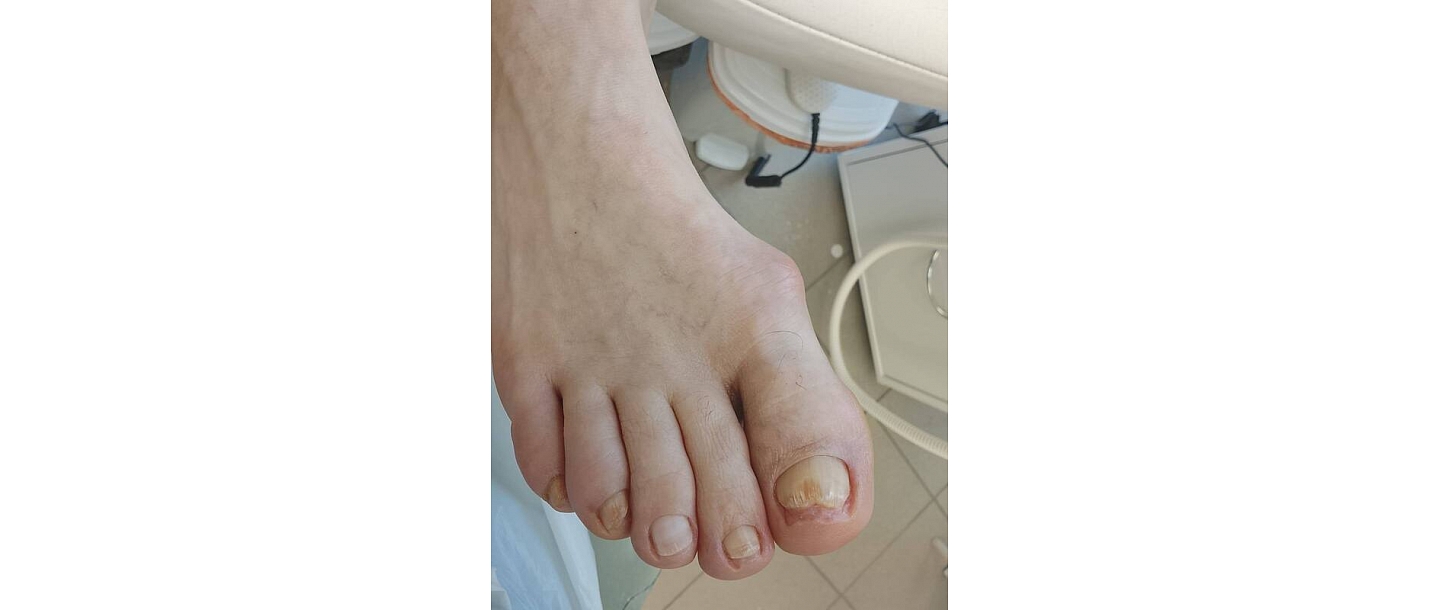Nail fungus treatment