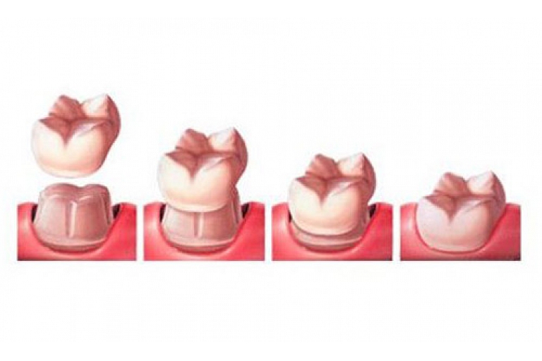 Dental implants
