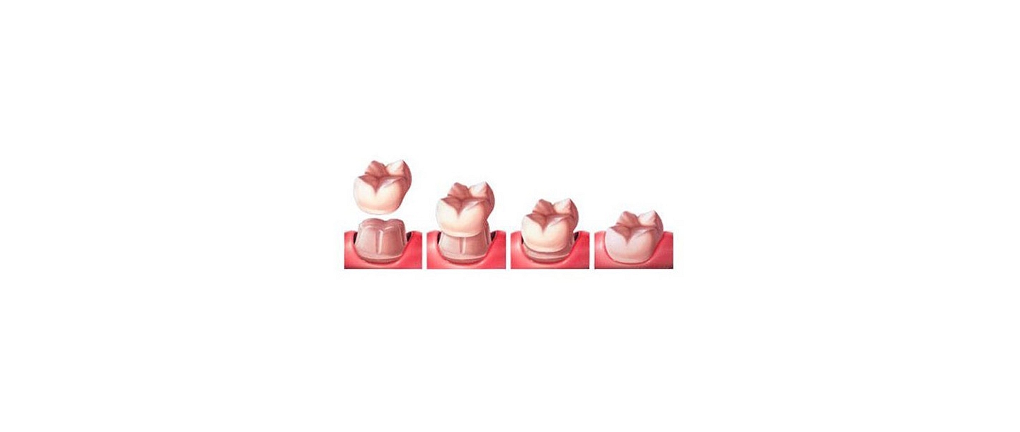 Зубные имплантаты