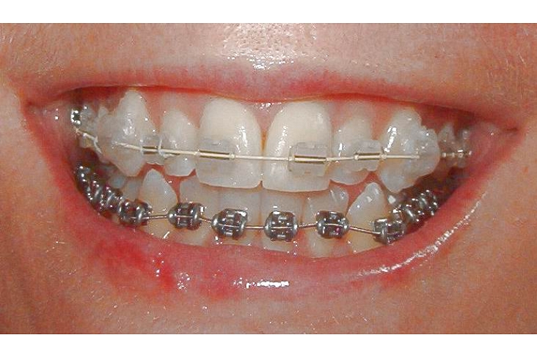 Braces