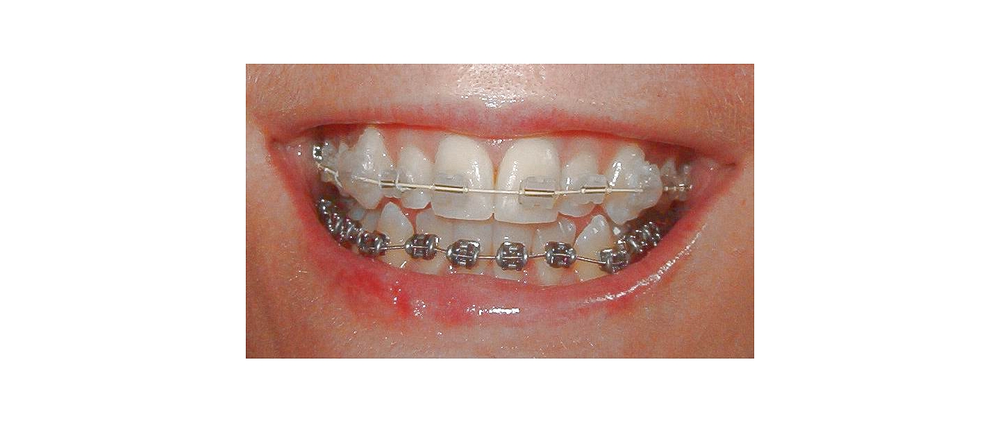 Брекеты