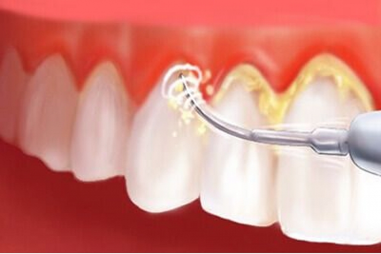 Plaque and tartar removal