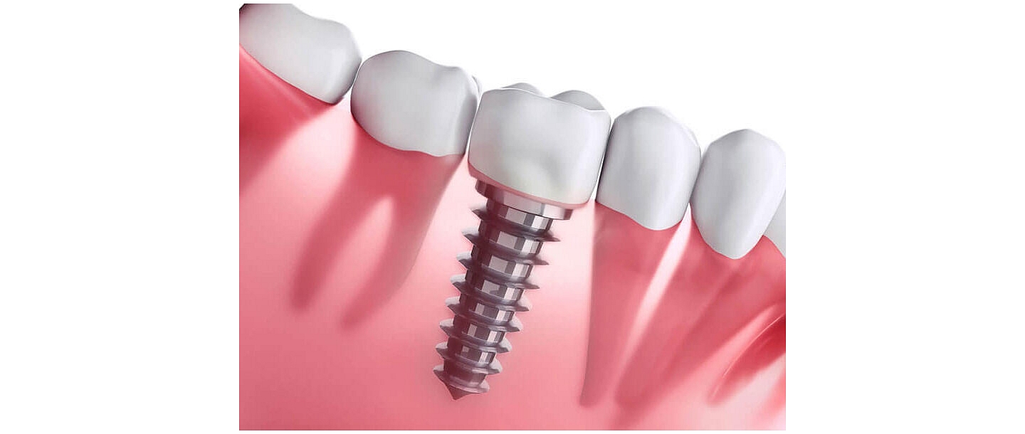 Dental implants