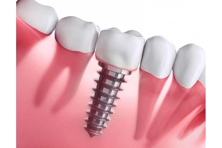 Dental implants