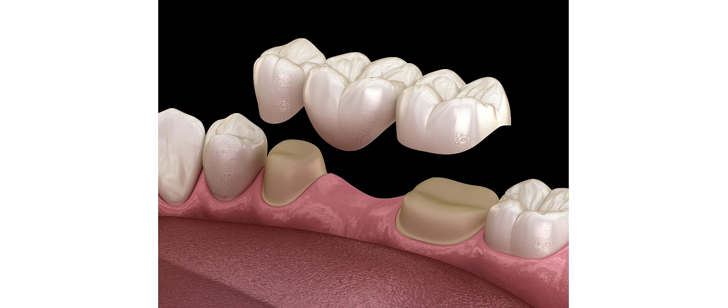 Dental bridge