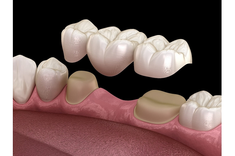 Dental bridge