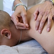 Acupuncture
