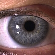 Vision correction