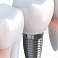 Zobu implantācija