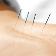 Acupuncture