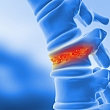 Propriocepcijas principi osteoporotisko skriemeļu lūzumu ārstēšanā 